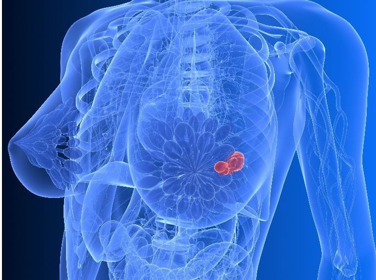 Screening gratuit pentru depistarea cancerului mamar, la Miercurea Ciuc