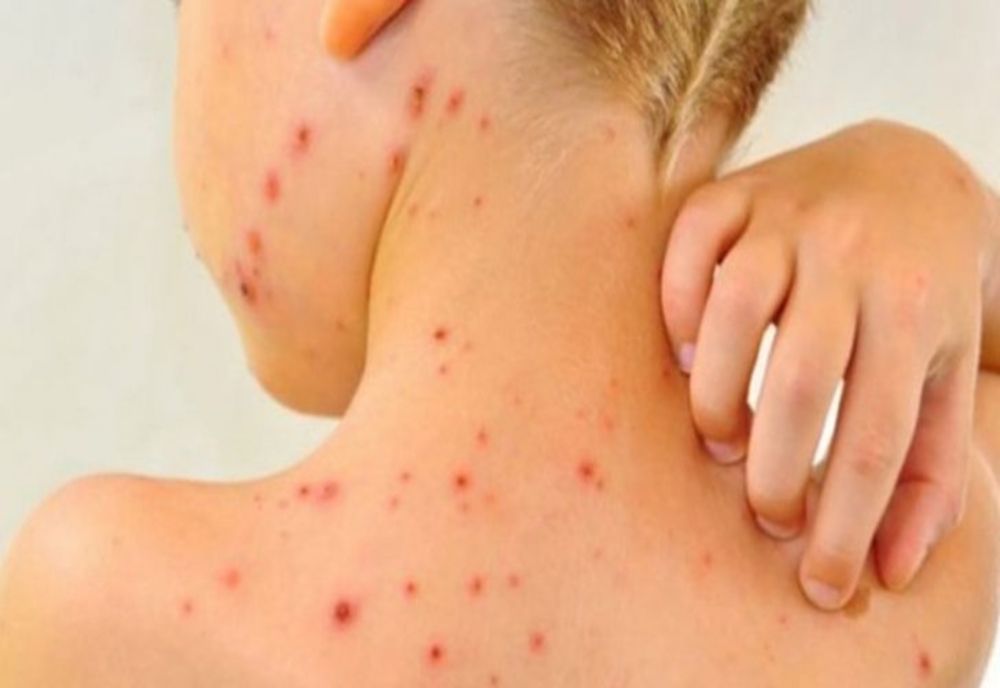 Încă un deces cauzat de rujeolă