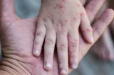 Risc uriaș de epidemie de rujeolă în România. Vaccinul ROR lipsește în mai multe județe